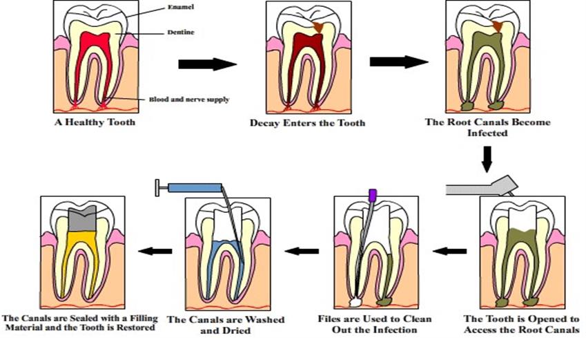 root canal illustration
